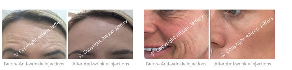Before & After Results Botox